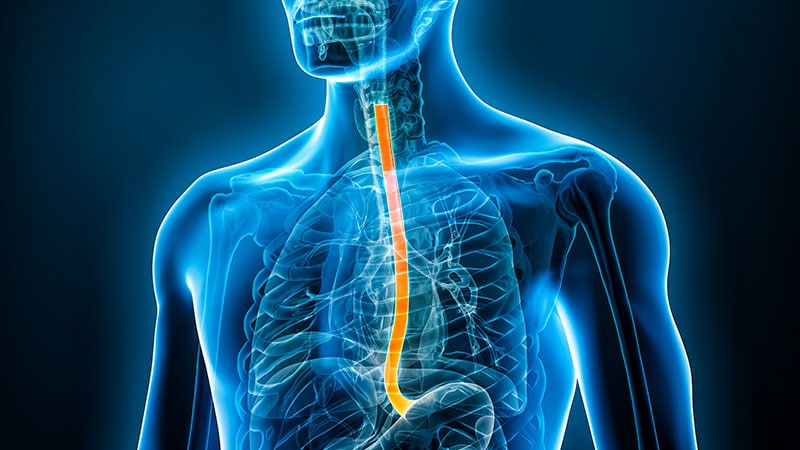 Barrett's Esophagus: Patient-Centered Tx Approach Is Key