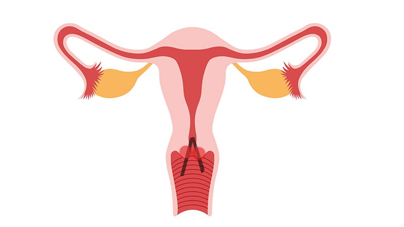 Non-Radical Surgery a Win-Win for Early Cervical Cancer