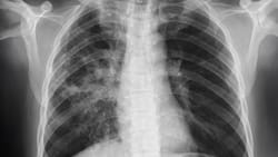Lung Cancer Screening Unveils Hidden Health Risks