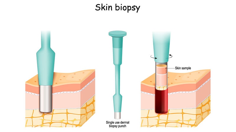 Skin Test Accurately Detects Neurodegenerative Disorders