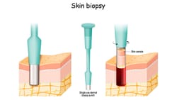 Skin Test Accurately Detects Neurodegenerative Disorders