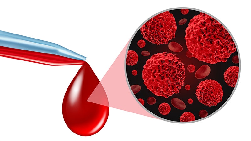 Le dépistage sanguin du CCR est prometteur mais manque d’efficacité