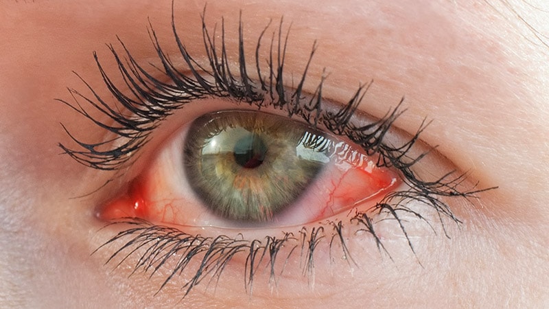 Ocular Microbiome May Be Dry Eye Culprit