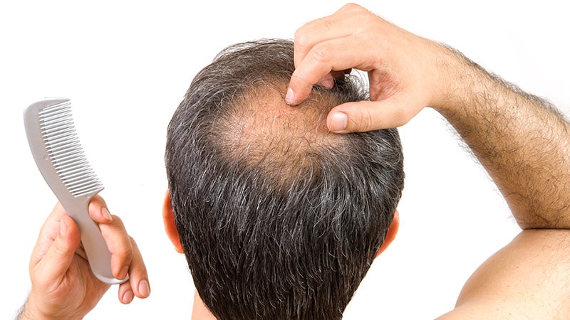 Hair Loss: Experts Provide Recommendations on Oral Minoxidil