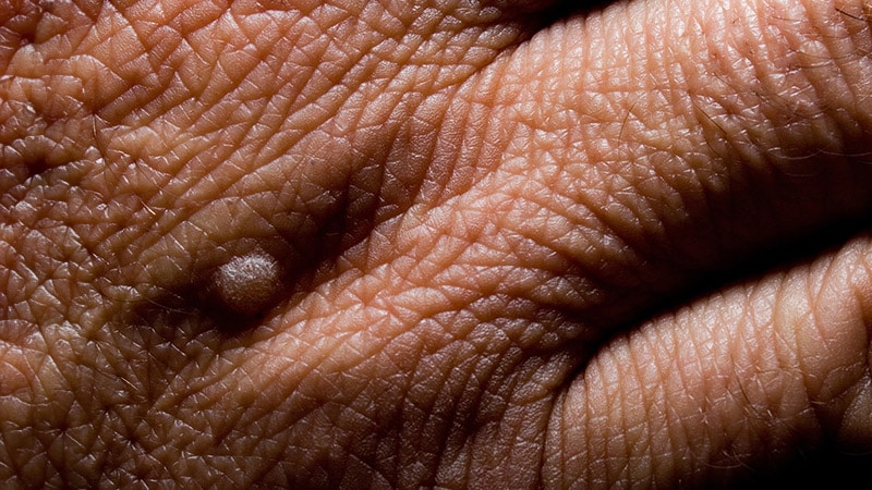 Intralesional Wart Treatments Are Among Options to Consider