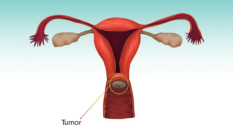 Hypofractionated RT Limits Toxic Effects in Cervical Cancer