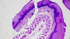 New Staging Paradigm Proposed for Advanced cSCC