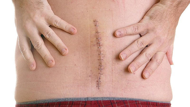 Diabetes/Weight Loss Med Linked to Repeat Spinal Surgery