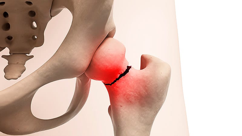 Study Finds Link Between Hip Fracture and Dementia Later On - Vimarsana News