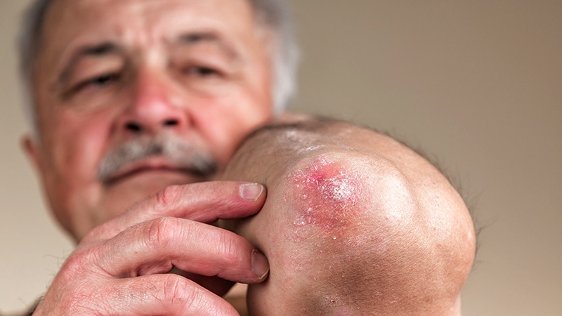 Infections Higher With JAK Inhibitors in Eczema Study