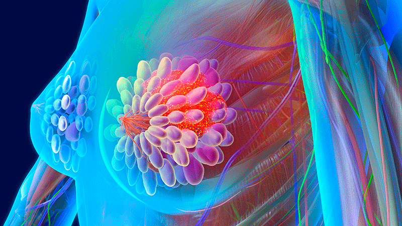 Factors Linked to Survival Outcomes in Mets Breast Cancer