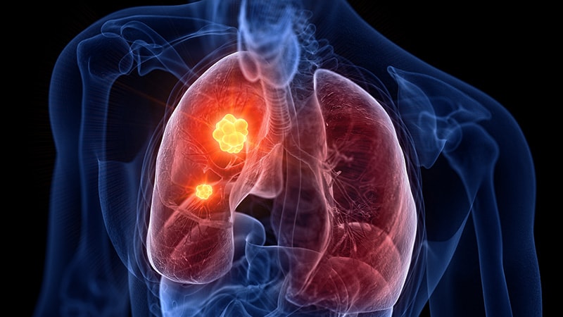 'Outstanding' Results for Osimertinib: Stage III EGFR+ NSCLC