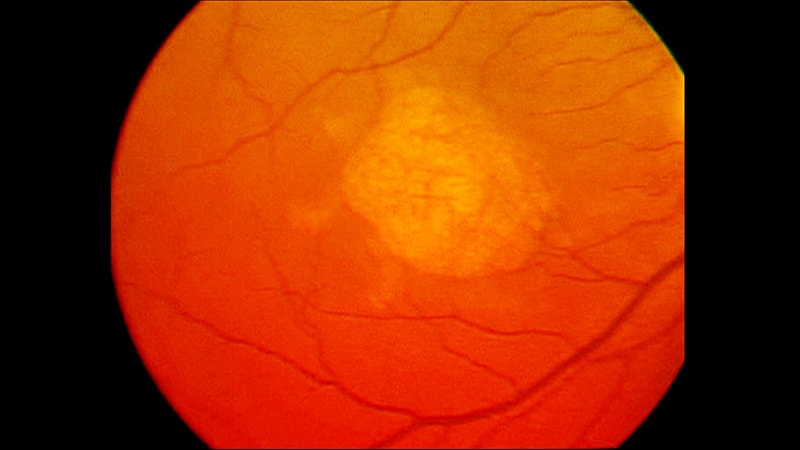 Melatonin May Cut Risk for Age-Related Eye Disease
