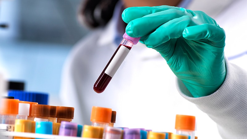 Blood Test a ‘Game Changer’ for Faster Stroke Diagnosis, Tx