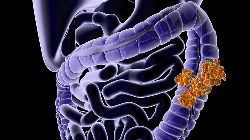 Debulking Does Not Improve Survival in Multiorgan Mets CRC