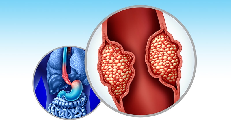 ESOPEC: FLOT Bests CROSS in Resectable Esophageal Cancer
