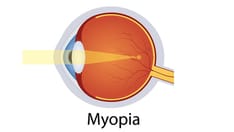 EMA Recommends Ryjunea for Pediatric Myopia