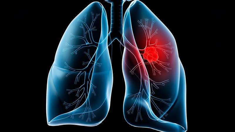 Essayez ces étapes pour stimuler les dépistages du cancer du poumon