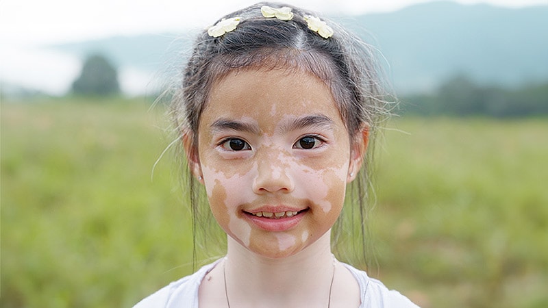 Response Rates With Vitiligo Rx Higher Among Adolescents