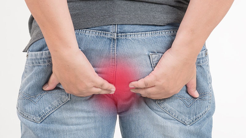 Hemorrhoidal Disease Management: When and How to Intervene