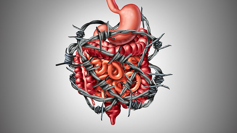 Half of the patients develop prolonged irritable bowel syndrome after gastroenteritis