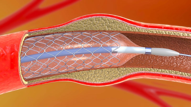 No Benefit to Anticoagulation After STEMI Revascularization