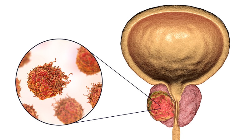 Radium-223 Plus Enzalutamide Ups Survival in Prostate Cancer