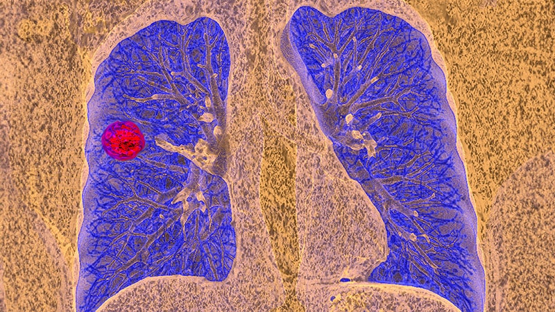 No DFS Profit With Adjuvant Durvalumab in Early NSCLC