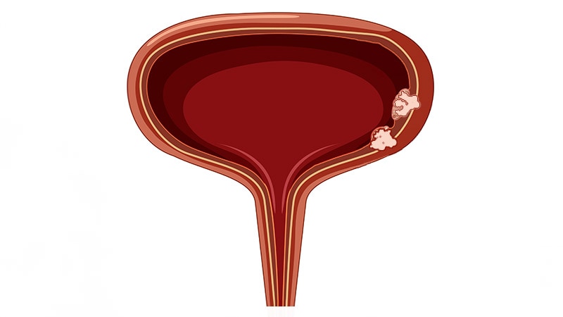 FDA Okays Perioperative Durvalumab for Bladder Cancer