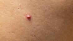 semaglutide hidradenitis suppurativa HS Symptoms Eased by Semaglutide-Aided Weight Loss
