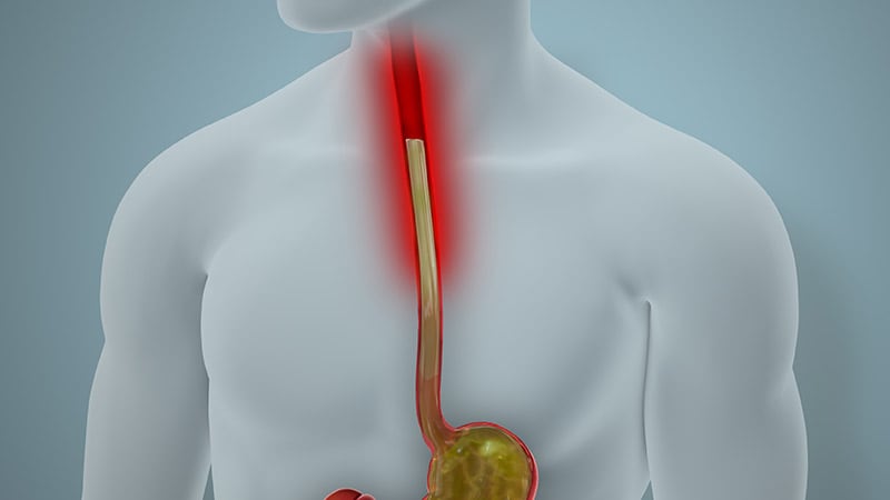 New Endoscopic Method for GERD Diagnosis Shows High Accuracy