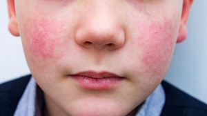 Rising Human Parvovirus Cases: What to Know