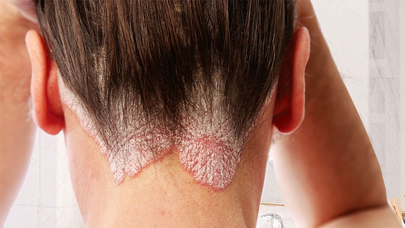 Significant Improvement in Psoriasis Seen With Oral Drug