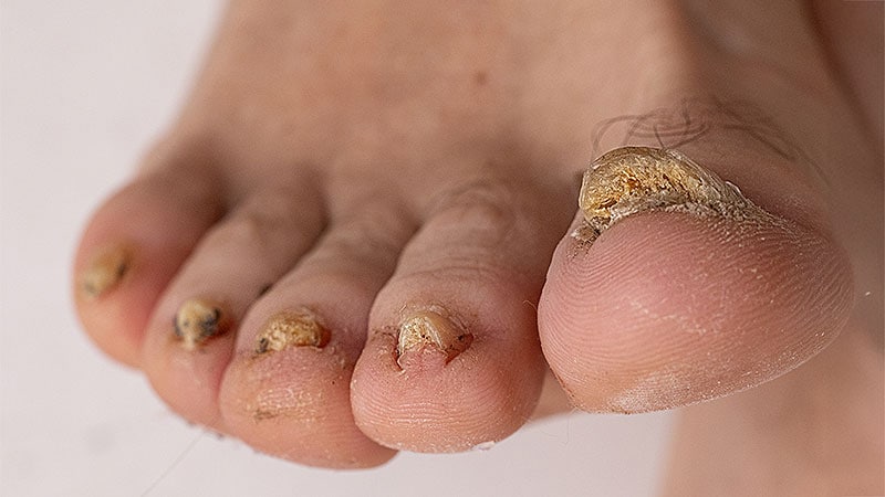 Red Flags in Nail Disease Every Dermatologist Should Know