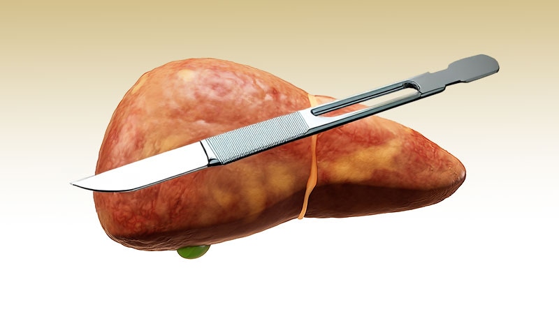 Surgery Better Than Obesity Drugs for Some With MASLD