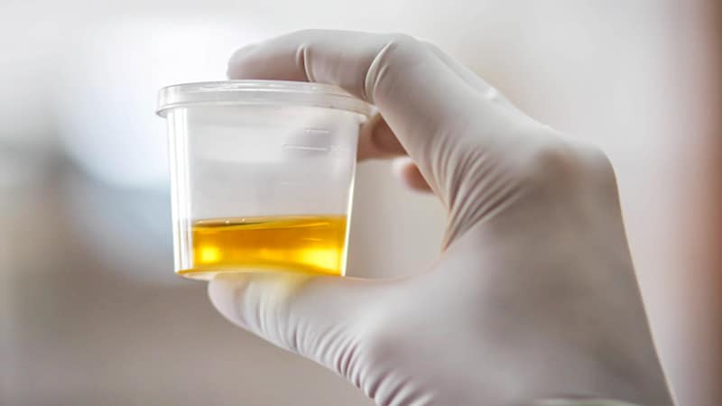 24-Hour Urine Testing in A number of Myeloma: Time to Cease?