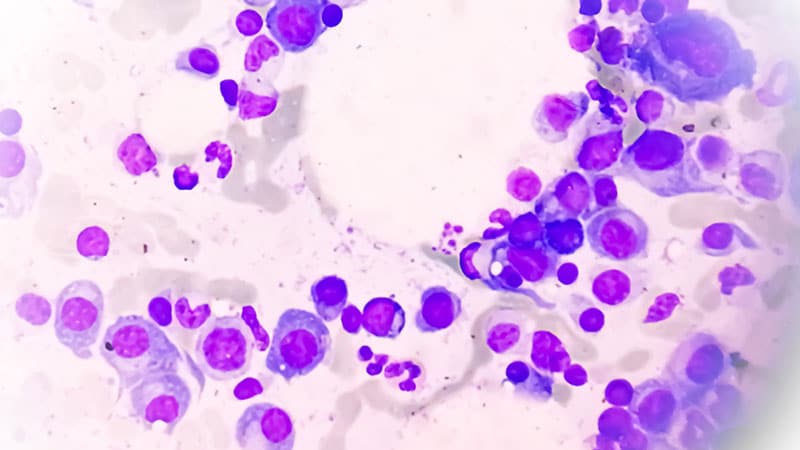 FDA Consulting: Daratumumab Wins, Glofitamab ล้มเหลว FDA Consulting: Daratumumab Wins, Glofitamab ล้มเหลว
