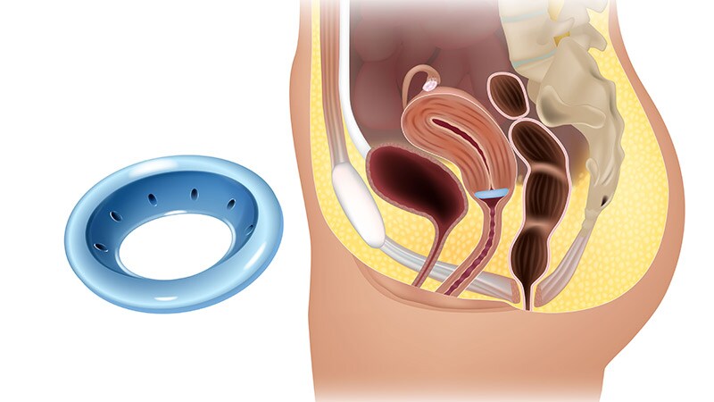 Racial Disparities in the Follow-up of Pelvic Organ Prolapse