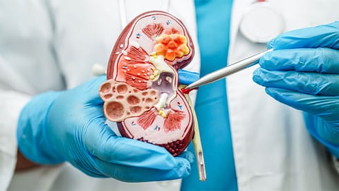 Chronic Kidney Disease