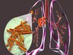 photo of lung tuberculosis