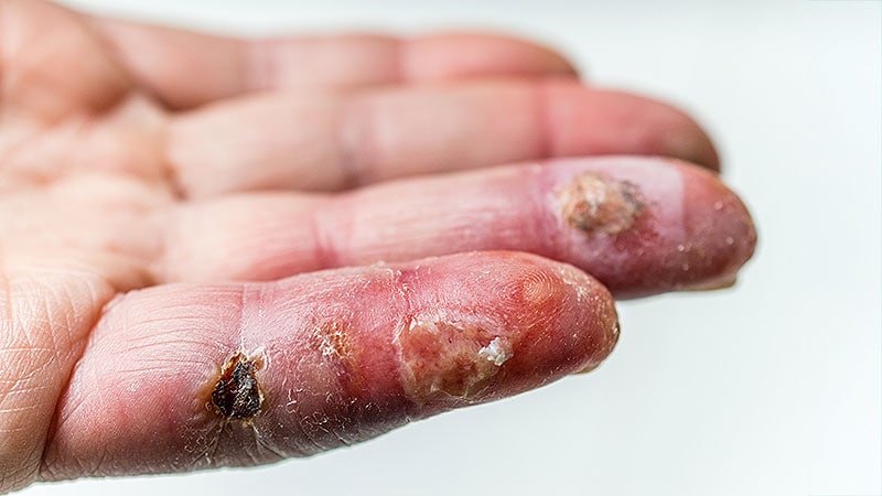 Flesh-Eating Bacteria Surge in Gulf Coast States