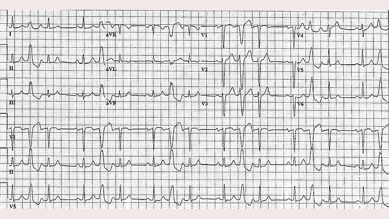 ECG Challenge: Irregular Pulse and Asymptomatic