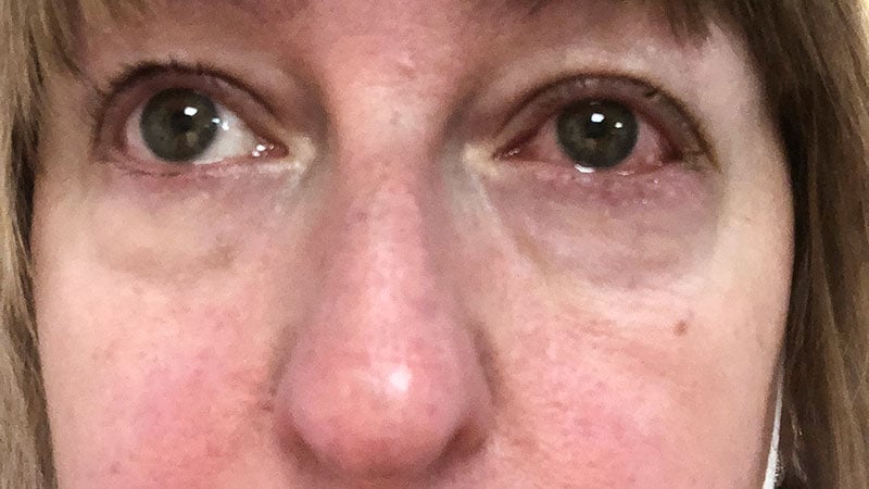 Ocular Rosacea Underappreciated in Dermatology and Beyond