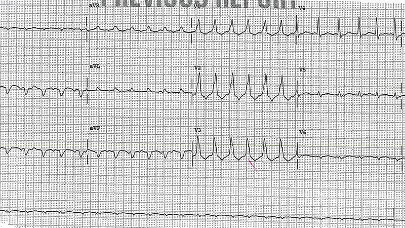ECG Challenge: Heart Racing After Bypass Surgery