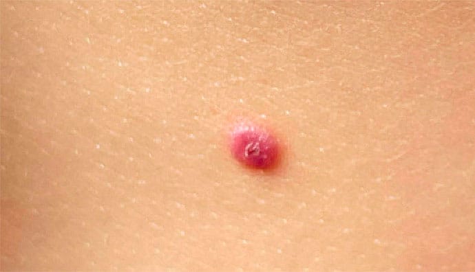 A 2-Year-Old Girl With a Single Pink 'Bump' on Her Abdomen