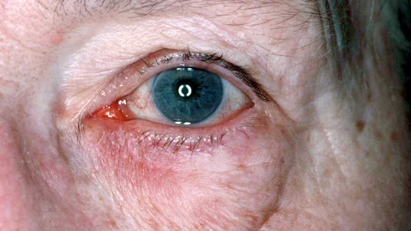 Topical Ivermectin Among Rx Options for Ocular Rosacea