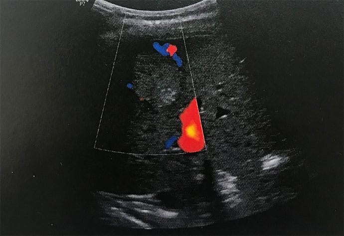 Coffee Drinker With Severe Abdominal Pain and Mild Pruritus
