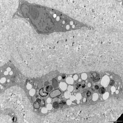 photo of carotid microplastics