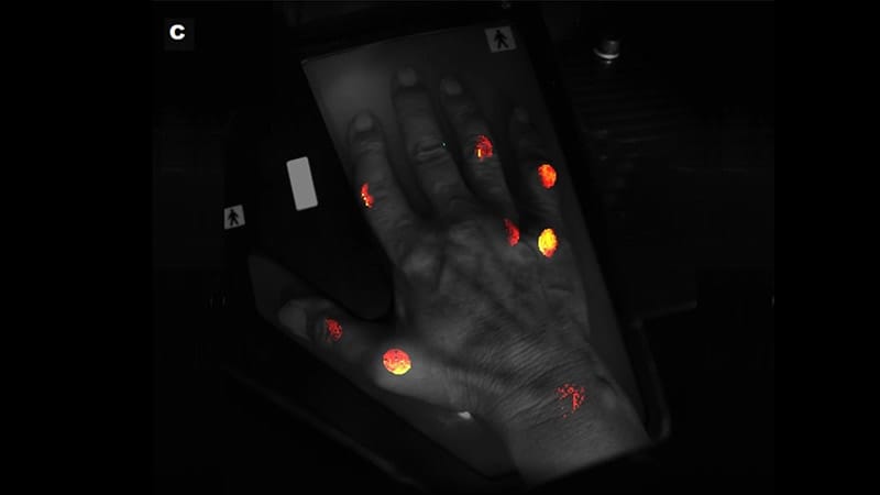 Optical Tool Matches MRI in Detecting Joint Inflammation