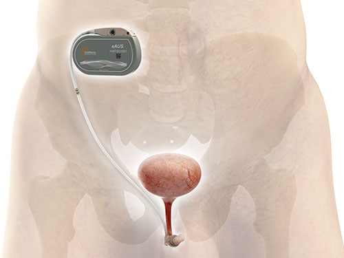 photo of The UroActive System